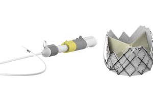 健适医疗"J-VALVE® TF经导管主动脉瓣膜系统"获批—数字化转型网www.szhzxw.cn