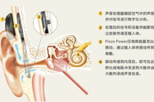 科利耳®澳晰亚™Osia™ 2系统中国大陆上市——数智化转型网www.szhzxw.cn